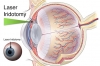 Điều trị Glocom (Cườm nước) bằng Laser không cần phẫu thuật tại BV Tâm Trí Đồng Tháp