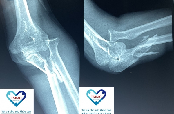 Phẫu thuật và điều trị thành công ca gãy xương kiểu Monteggia cẳng tay trái phức tạp