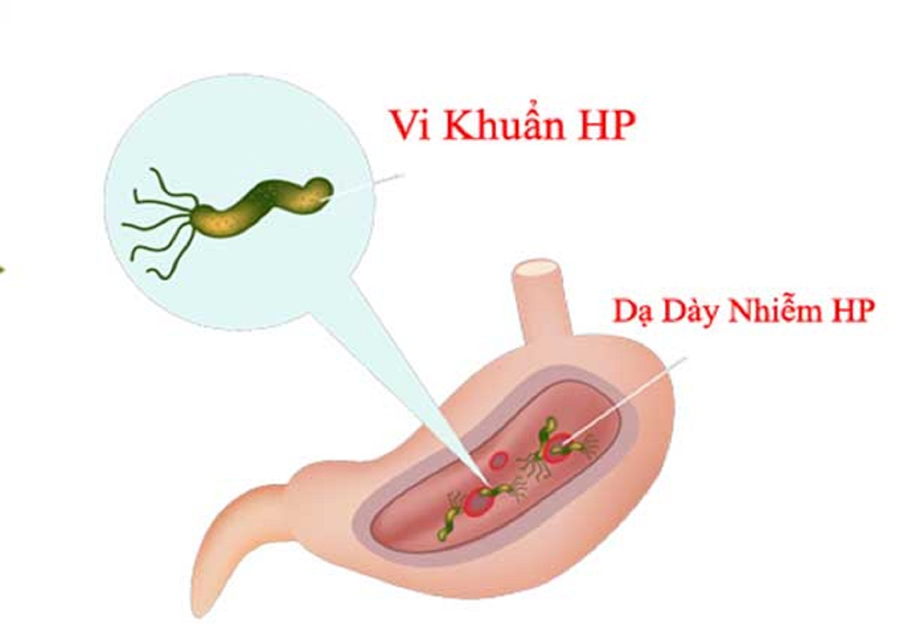 co-vi-khuan-hp-trong-da-day-1-1630242120588681090676