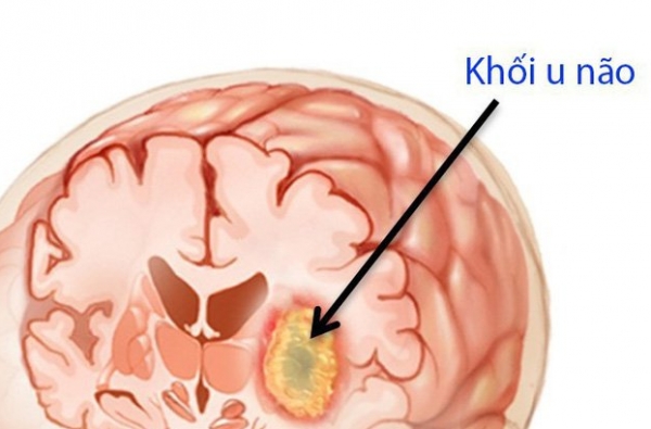 U NÃO LÀ GÌ? CÁCH ĐIỀU TRỊ VÀ PHÒNG NGỪA