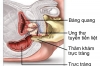 Ý nghĩa việc phát hiện sớm ung thư tuyến tiền liệt