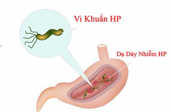 VI KHUẨN HELICOBACTER PYLORI & BỆNH DẠ DÀY