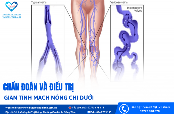 CHẨN ĐOÁN VÀ ĐIỀU TRỊ GIÃN TĨNH MẠCH NÔNG CHI DƯỚI