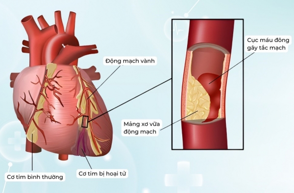 ĐỐI TƯỢNG NÀO CÓ NGUY CƠ HẸP ĐỘNG MẠCH VÀNH VÀ DẤU HIỆU NHẬN BIẾT BỆNH