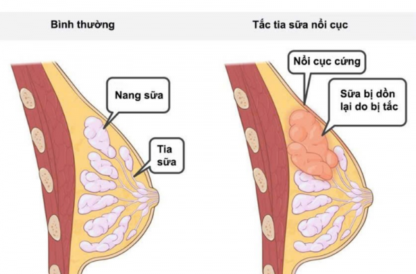 HƯỚNG DẪN CHĂM SÓC VÀ PHÒNG NGỪA VIÊM TẮC TUYẾN SỮA Ở SẢN PHỤ SAU SINH