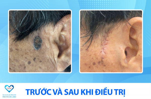 PHÁT HIỆN SỚM – ĐIỀU TRỊ HIỆU QUẢ UNG THƯ DA TẠI BỆNH VIỆN ĐA KHOA TÂM TRÍ CAO LÃNH