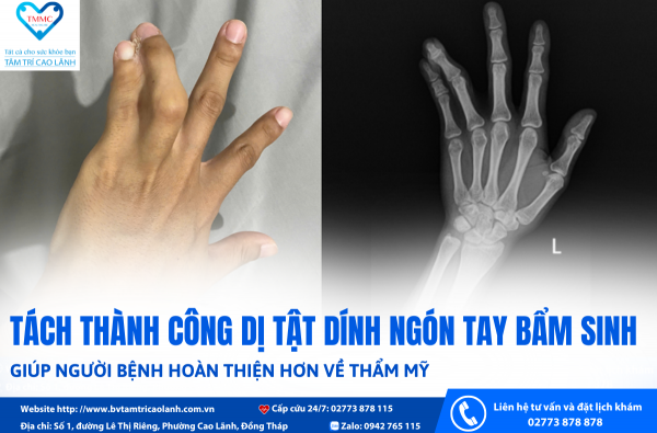TÁCH THÀNH CÔNG DỊ TẬT DÍNH NGÓN TAY BẨM SINH, GIÚP NGƯỜI BỆNH HOÀN THIỆN HƠN VỀ THẨM MỸ