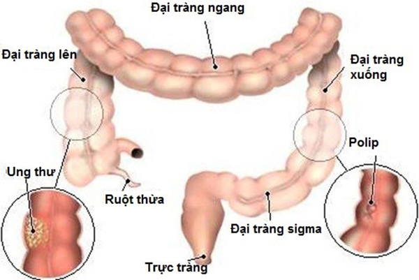 ung-thu-dai-truc-trang-1