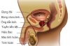 Ý nghĩa việc phát hiện sớm ung thư tuyến tiền liệt