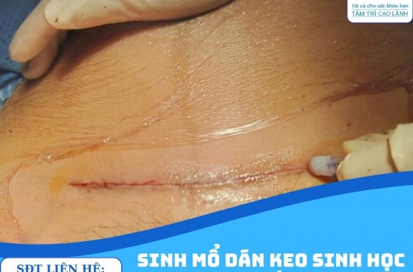 SINH MỔ DÁN KEO SINH HỌC NHƯ THẾ NÀO?