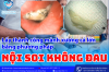 NỘI SOI KHÔNG ĐAU – XỬ LÝ THÀNH CÔNG TRƯỜNG HỢP HÓC XƯƠNG CÁ LỚN – AN TOÀN – HIỆU QUẢ TẠI BỆNH VIỆN ĐA KHOA TÂM TRÍ CAO LÃNH