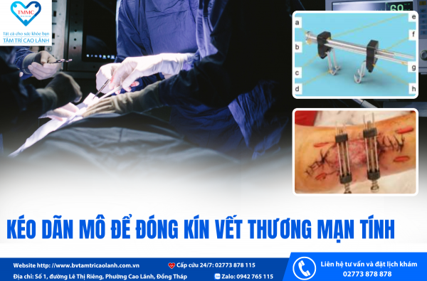 KÉO DÃN MÔ ĐỂ ĐÓNG KÍN VẾT THƯƠNG MẠN TÍNH