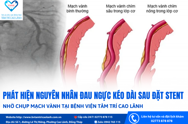 PHÁT HIỆN NGUYÊN NHÂN ĐAU NGỰC KÉO DÀI SAU ĐẶT STENT NHỜ CHỤP MẠCH VÀNH TẠI BỆNH VIỆN TÂM TRÍ CAO LÃNH