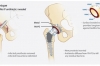 Lớp phủ khớp giả mới giúp ngăn ngừa nhiễm trùng