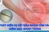 PHÁT HIỆN DỊ VẬT ĐẦU NHỌN CẮM VÀO NIÊM MẠC MANH TRÀNG