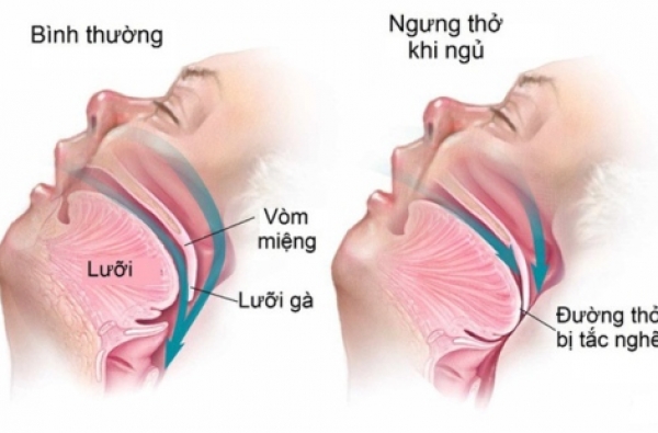 NGỦ NGÁY VÀ NGƯNG THỞ KHI NGỦ CÓ THỂ GÂY TỔN THƯƠNG CHO NÃO BỘ