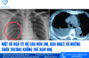 MỘT CÚ NGÃ TỪ ĐỘ CAO HƠN 3M, ĐAU NGỰC VÀ NHỮNG CHẤN THƯƠNG KHÔNG THỂ XEM NHẸ