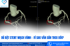 ĐÃ ĐẶT STENT MẠCH VÀNH – VÌ SAO VẪN CẦN THEO DÕI?