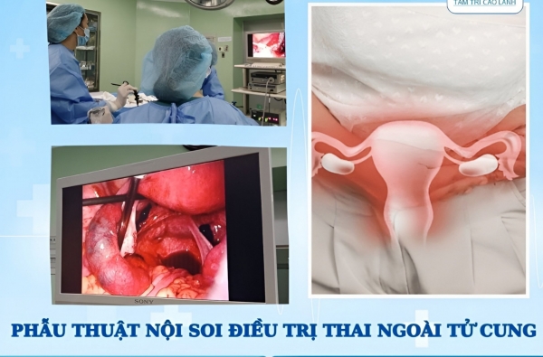 PHẪU THUẬT NỘI SOI ĐIỀU TRỊ THAI NGOÀI TỬ CUNG