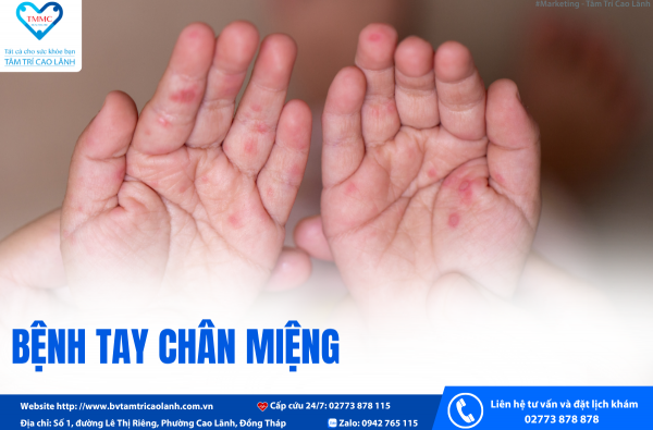 Bệnh tay chân miệng