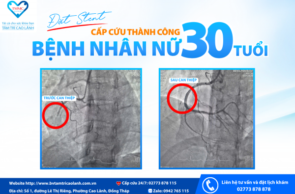 CẢNH BÁO NHỒI MÁU CƠ TIM Ở NGƯỜI TRẺ: CẤP CỨU THÀNH CÔNG BỆNH NHÂN NỮ 30 TUỔI