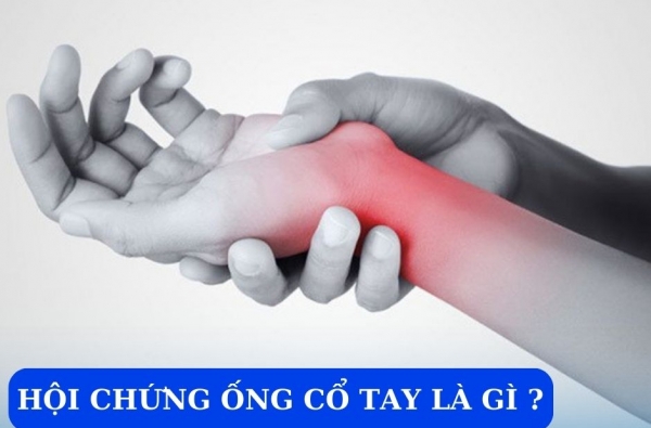 HỘI CHỨNG ỐNG CỔ TAY LÀ GÌ?