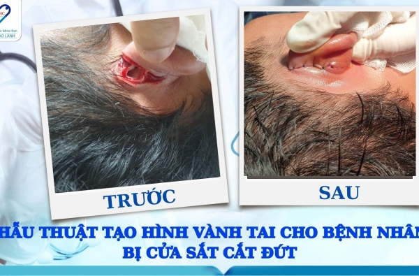 PHẪU THUẬT TẠO HÌNH VÀNH TAI CHO BỆNH NHÂN BỊ CỬA SẮT CẮT ĐỨT