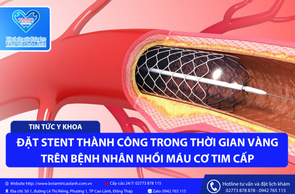 CHỤP MẠCH VÀNH ĐẶT STENT TRÊN BỆNH NHÂN NHỒI MÁU CƠ TIM CẤP TRONG THỜI GIAN VÀNG HI HỮU