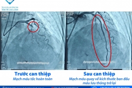 Bệnh viện Tâm Trí Cao Lãnh cứu sống 5 ca nhồi máu cơ tim cấp trong giờ vàng